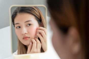 Cara Menghilangkan Bekas Jerawat yang Bisa Kamu Coba