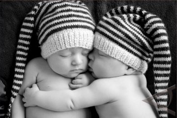 Orang tua bayi kembar siam kesulitan biaya operasi