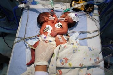 Bayi Kembar Siam Dempet Dada Akhirnya Meninggal 