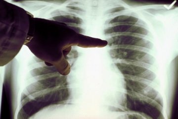 Deteksi dini perpanjang asa hidup penderita kanker paru-paru