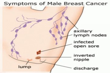 15 persen pria terkena kanker payudara