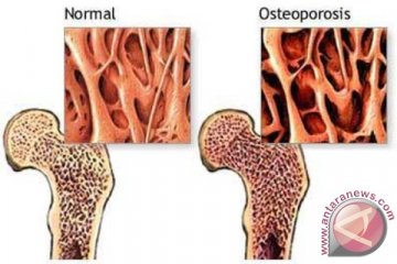 Efek osteoporosis tinggi tubuh berkurang