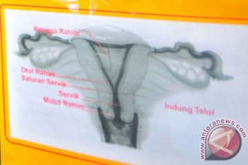 Alat kontrasepsi IUD dapat kurangi risiko kanker serviks  