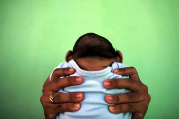 Thailand diagnosis mikrosefali terkait Zika pertama pada bayi