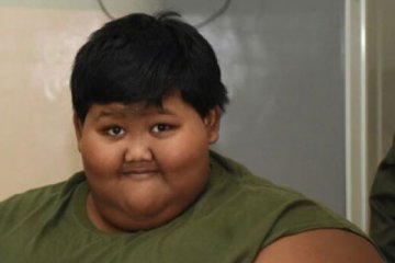 "Perawatan bocah obesitas ditanggung BPJS"