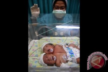 Bayi Perempuan Berkepala Dua