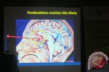 Operasi tumor otak kini bisa melalui alis mata