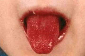 Dokter paparkan sejumlah ciri kanker lidah yang perlu diwaspadai