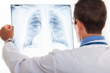 Tanya jawab kanker paru, benarkah bisa dialami orang muda?