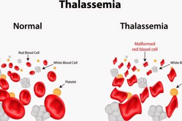 Dokter anjurkan skrining talasemia jauh hari sebelum menikah