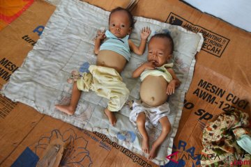 Bayi Kembar Penderita Gizi Buruk
