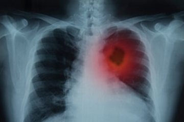 88 persen pasien kanker paru wafat tahun yang sama kanker ditemukan