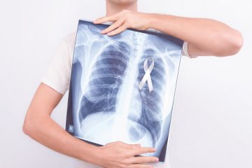 Saran dokter untuk pasien kanker paru di tengah pandemi
