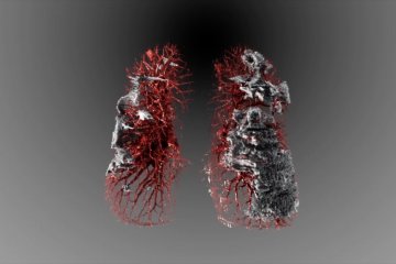 Visualisasi dampak COVID-19 terhadap paru-paru