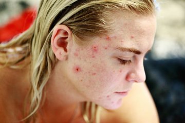 Muncul alergi kulit selama WFH? Mungkin gara-gara stres