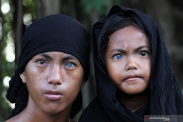 Sindrom Waardenburg di suku Buton dan Muna