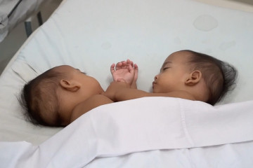 Operasi pemisahan bayi kembar siam di Medan berjalan lancar