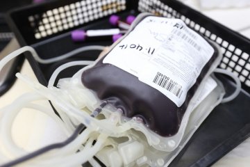 Benarkah penyintas thalassemia butuh transfusi darah seumur hidup?