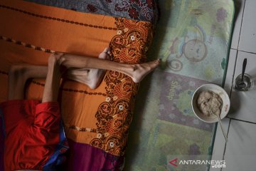 Penderita gizi buruk di Pangandaran