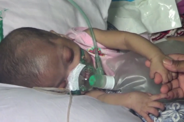 IDAI sebut 1.000 bayi meninggal akibat penyakit jantung bawaan kritis