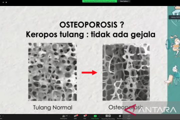 Perosi: Pandemi COVID-19 berpengaruh pada peningkatan osteoporosis