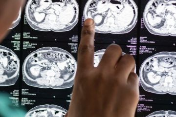 Kasus stroke meningkat, RS PON kembangkan Brain Check Up deteksi dini