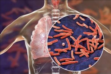 Jumlah kematian tuberkulosis pada 2022 meningkat 12 persen di Malaysia