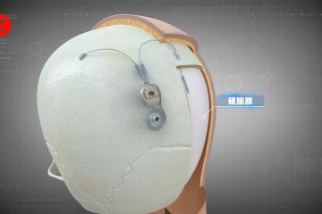 Operasi implan otak pulihkan motorik pria lumpuh di China