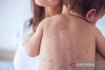 Kala campak mengintai balita