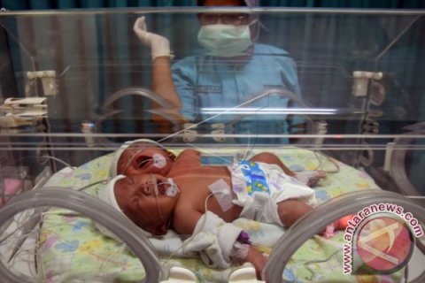 Bayi Perempuan Berkepala Dua