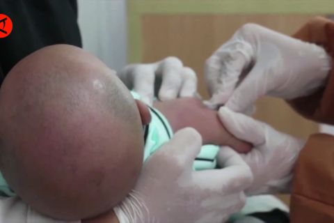 Kasus Polio bertambah, Kemenkes imbau lakukan PHBS dan vaksinasi
