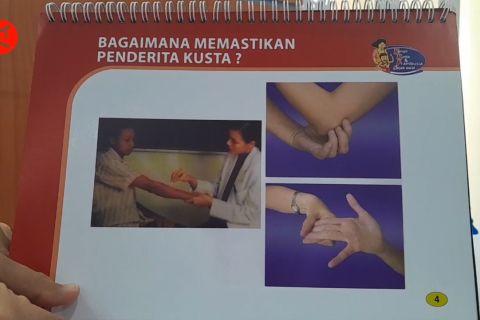 Temuan kasus kusta di Kota Ternate menurun