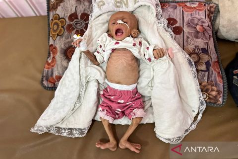 Bayi-bayi Palestina malnutrisi akibat krisis pangan, begini kondisi mereka saat ini