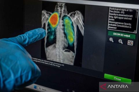 Cegah penularan TBC, ratusan warga DKI Jakarta ditarget jalani skrining gratis Tuberculosis