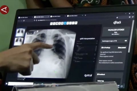 TBC bagai fenomena gunung es, PDPI ingatkan urgensi deteksi dini