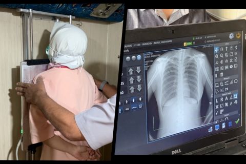 Tekan penyebaran TBC, Dinkes Kota Malang gencarkan screening mobile
