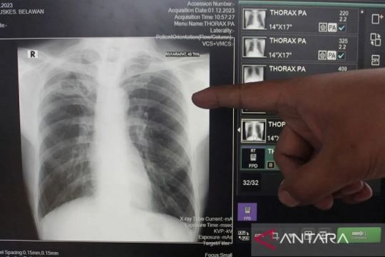 Rendahnya pengetahuan dan stigma menghambat pengobatan TBC