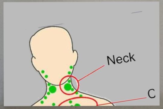 Jangan salah mengira, benjolan di leher bisa jadi bukan sekadar Flu