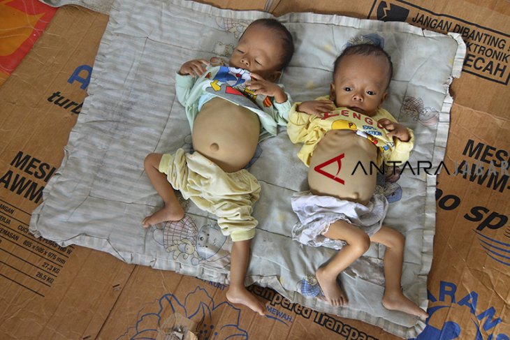 Bayi kembar penderita gizi buruk di Tasikmalaya