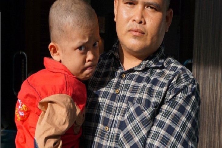 Bocah asal Tanjabtim menderita penyakit kulit kayu