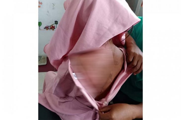 Kulit remaja putri ini melepuh akibat disiram air panas oleh ibu kandungnya