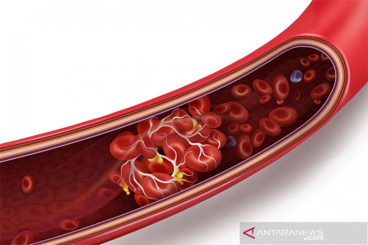 Italia laporkan empat meninggal akibat pembekuan darah vaksin AstraZeneca