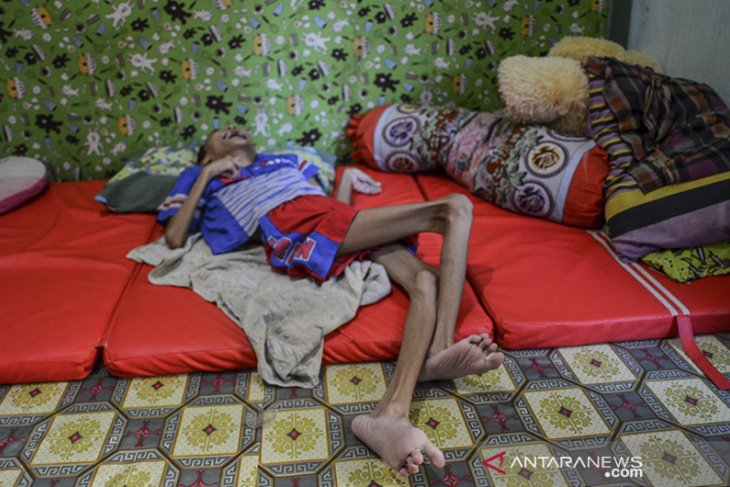 Penderita gizi buruk di Pangandaran 