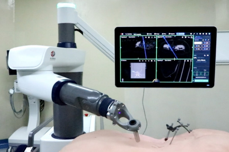 Satu-satunya di Indonesia, Eka hospital hadirkan robot navigasi obati skoliosis