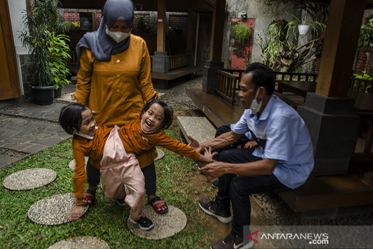 Anak kembar siam asal Garut 