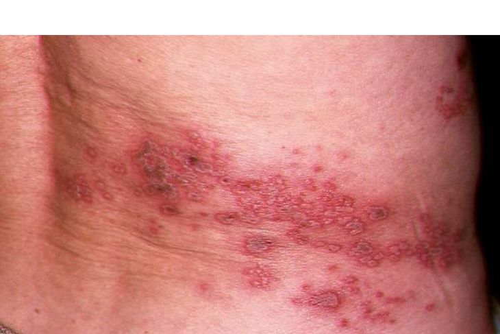 Orang-orang berusia di atas 50 tahun berisiko terkena herpes zoster