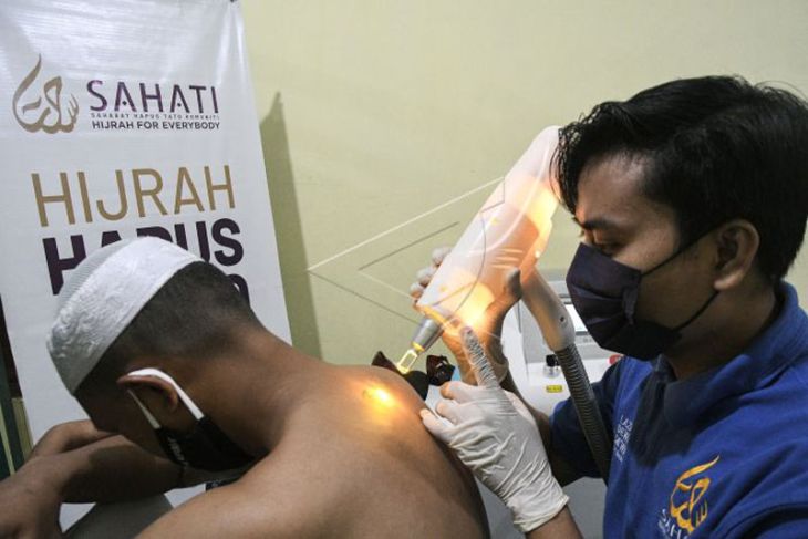 Layanan hapus tato gratis di Bekasi