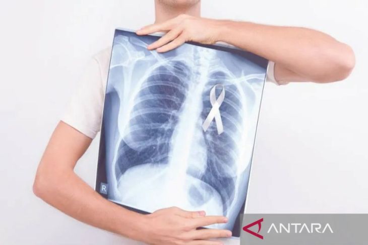 Dokter ingatkan sejumlah risiko penyebab kanker paru