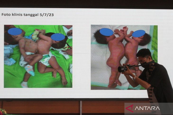 Pra operasi pemisahan bayi kembar Siam di RSSA Malang