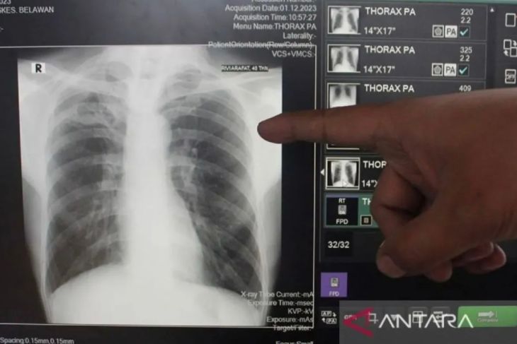 Menkes: Banyak pasien gagal sembuh TBC